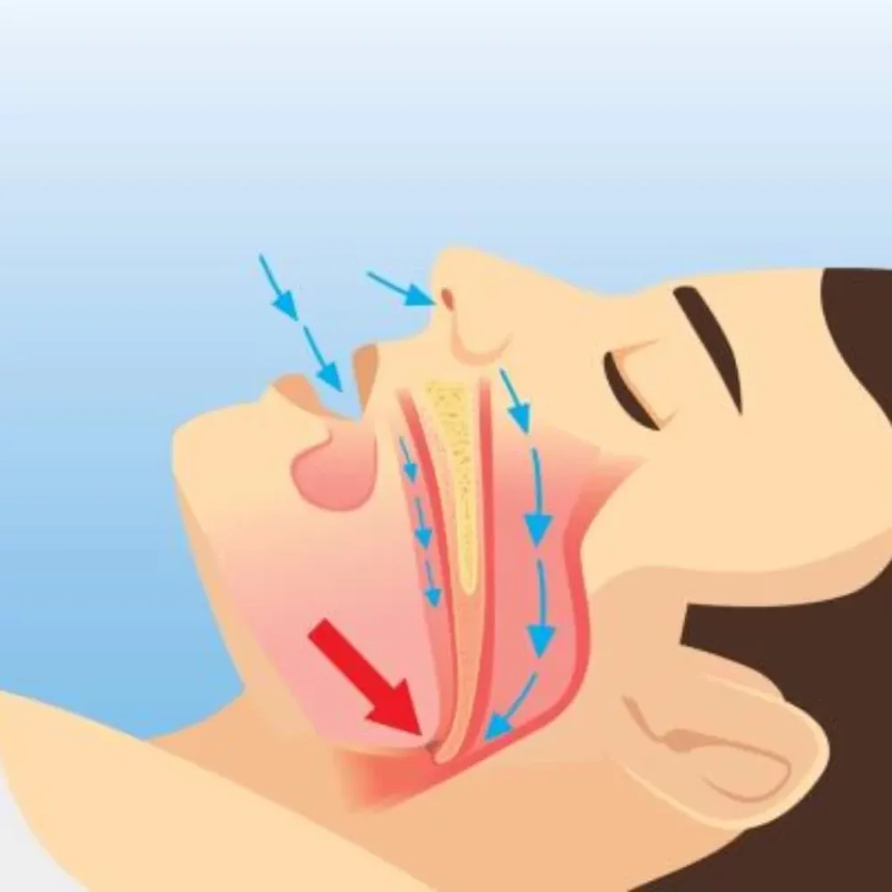 Manejar con apneas de sueño, un riesgo si no se trata a tiempo