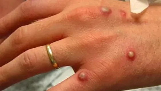 Salud de la Nación informó 170 casos confirmados en siete provincias