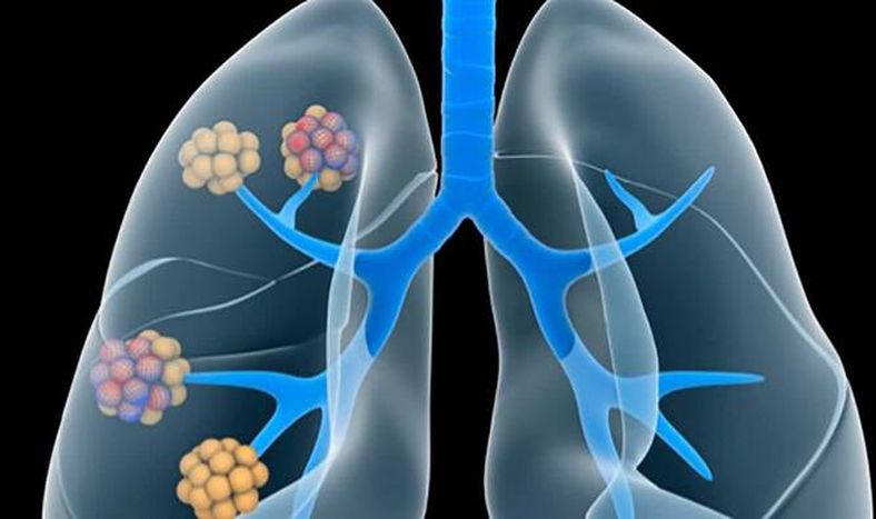 Hipertensión pulmonar: se considera dentro de las 7.000 enfermedades raras en el mundo