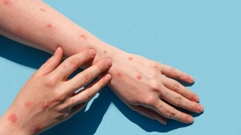 Mpox: aparece la erupción cutánea (exantema). Esta atraviesa distintas etapas (manchas, ampollas y costras) hasta que se seca y cae.&nbsp;