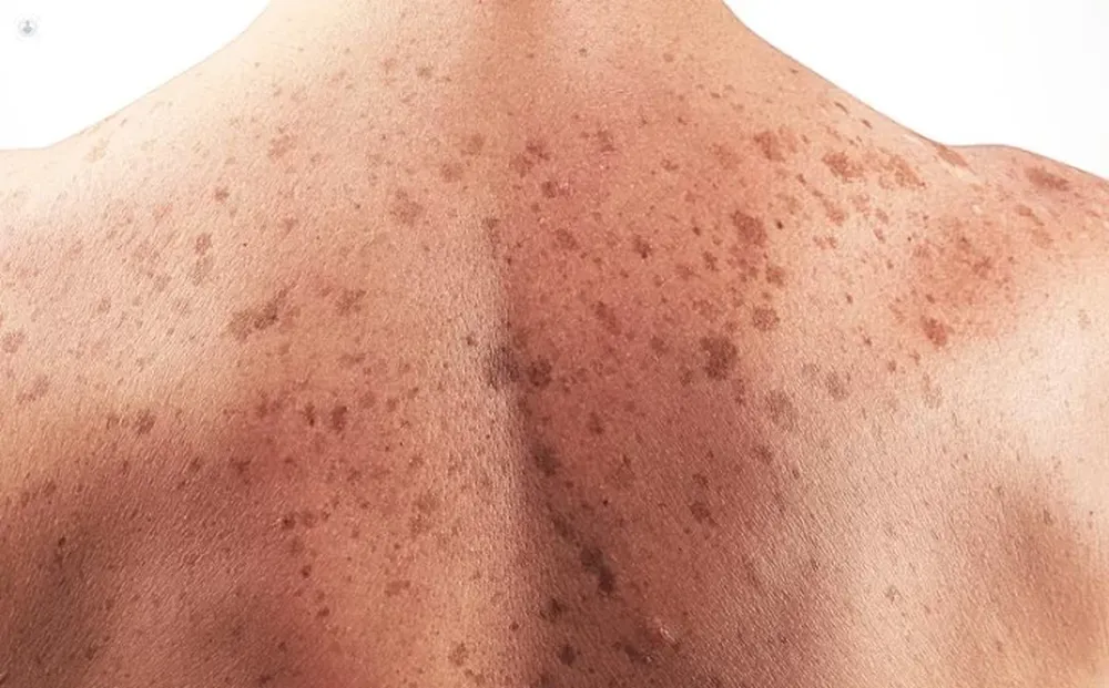 Cáncer de piel: advierten que lesiones inofensivas o lunares podrían ser “signo de alarma”