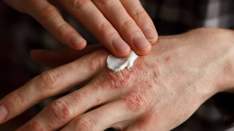 campana gratuita para detectar psoriasis y artritis psoriasica: como acceder a los turnos