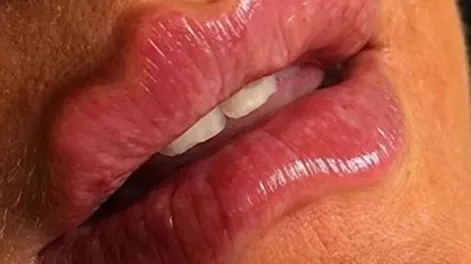 “Labios del diablo”, la peligrosa moda viral