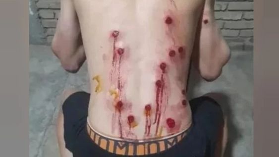 AL MENOS 15 perdigones de goma se le incrustaron en la espalda y un brazo a Agustín López. Quien le disparó cuando un colega conducía una moto, quedaría más complicado.