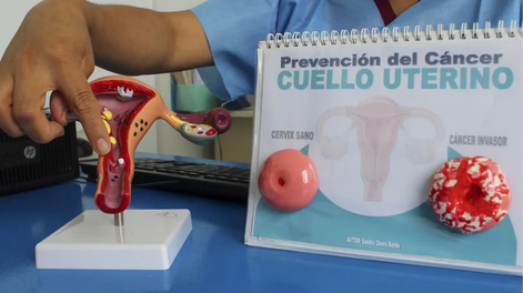 Cáncer de Cuello de Útero: San Juan se suma a una jornada de concientización federal y habrá un encuentro en el Hospital Rawson