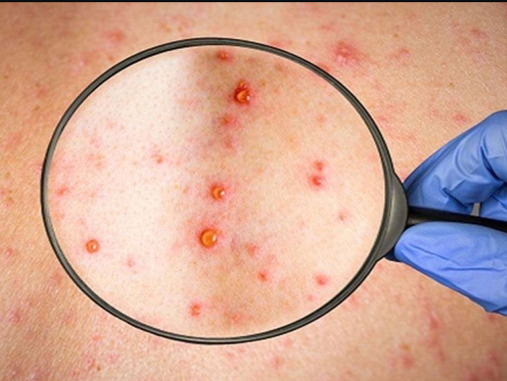 Chile declaró la alerta sanitaria por la viruela del mono