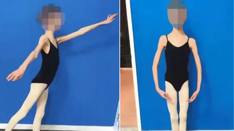 Un matrimonio sometió a su hija bailarina a una dieta extrema para impedir que creciera