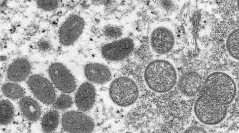 Confirmaron el quinto caso de viruela del mono en el país