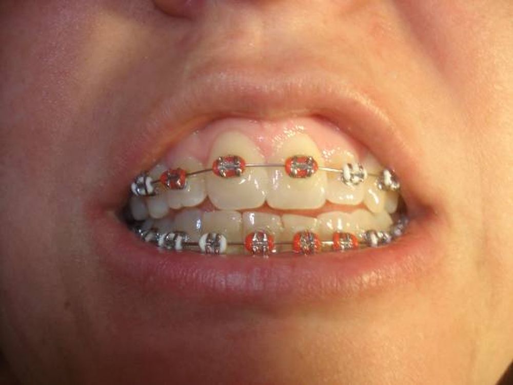 La ortodoncia se llena de color