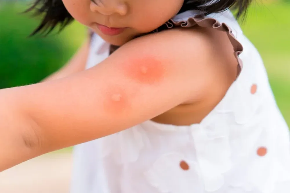 Día Internacional de la Lucha contra el Dengue: infografía para entender el riesgo y cuáles son los signos de alarma