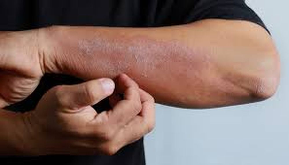 La demora en el acceso al tratamiento puede afectar significativamente la calidad de vida de los pacientes con dermatitis atópica