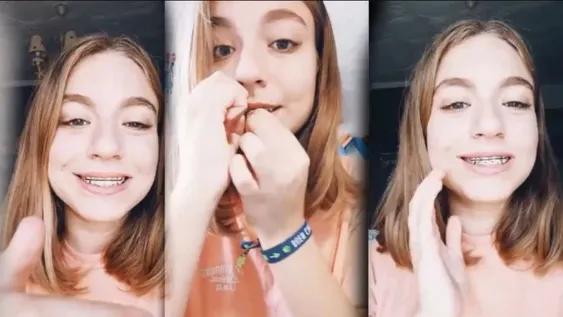 Los brackets falsos, la peligrosa moda de TikTok que siguen los jóvenes