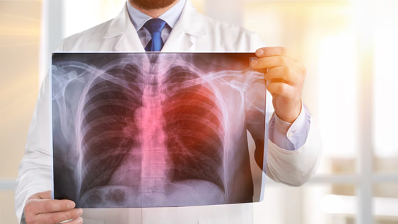 cerraron cinco centros de salud en rusia ante un posible brote de peste neumonica: que es y como se contagia