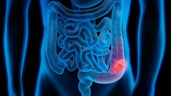Cada día se suman más de 40 casos de cáncer de colon