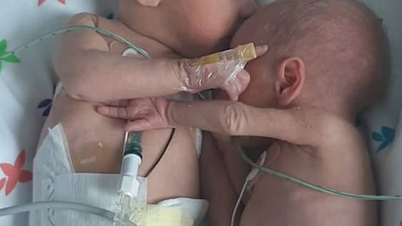 Dos gemelas prematuras separadas al nacer se dieron un abrazo al reencontrarse