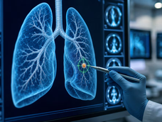 que es el adenocarcinoma pulmonar, el tumor maligno que le detectaron al papa leon xiv