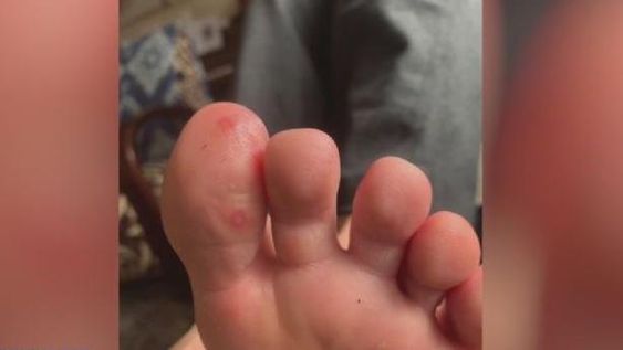 “Dedos Covid”: el nuevo síntoma que inquieta a los científicos