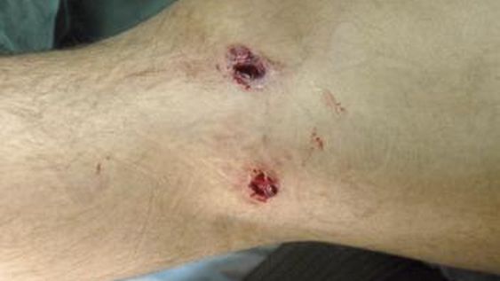 Su exsuegro lo atacó con un arma y le provocó heridas en ambas piernas