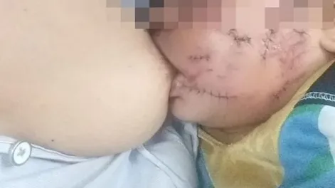 Un pitbull le desfiguró la cara a una beba