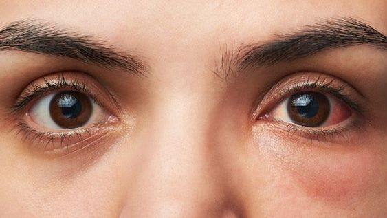 La conjuntivitis puede ser un síntoma de Covid-19
