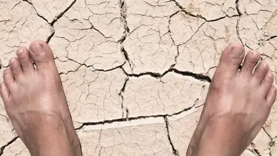 La sequía hace aumentar el riesgo de enfermedades y efectos en piel y pelo