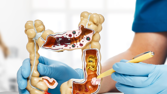 El impacto de una dieta poco saludable en el desarrollo de cáncer de colon en adultos jóvenes