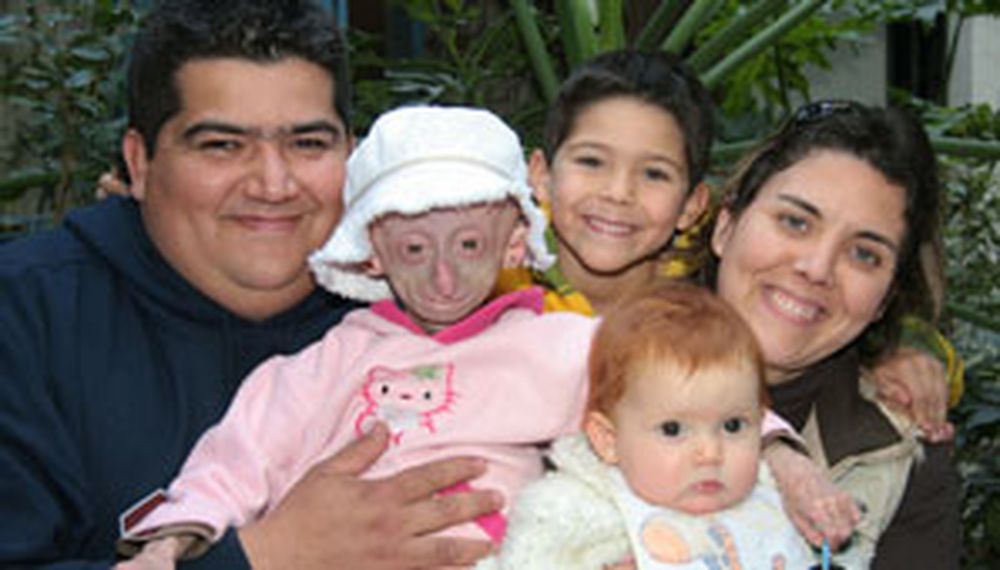 Murió Milagros, la nena que sufría de vejez prematura