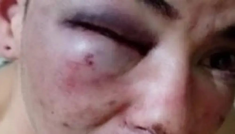 En un boliche: denunció que patovicas lo desfiguraron
