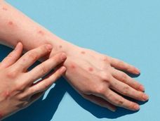 Mpox: aparece la erupción cutánea (exantema). Esta atraviesa distintas etapas (manchas, ampollas y costras) hasta que se seca y cae.&nbsp;