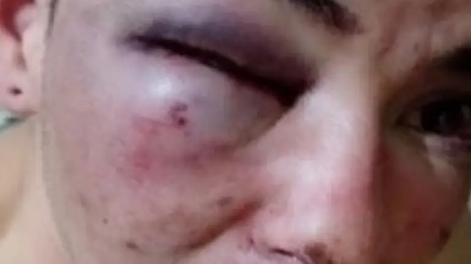 En un boliche: denunció que patovicas lo desfiguraron