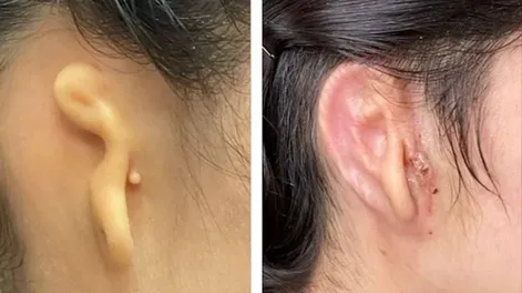 Trasplantaron por primera vez una oreja 3D hecha con células humanas
