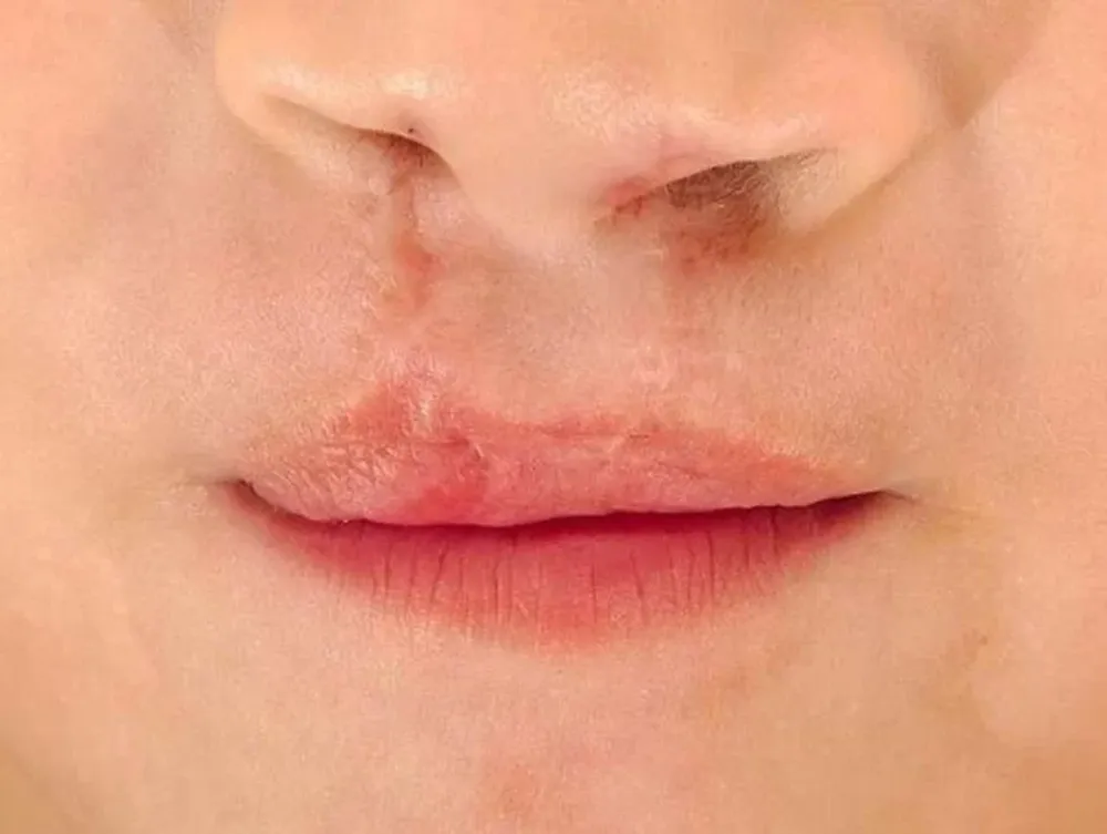Cuál es el componente clave del labio leporino y cuáles son las causas