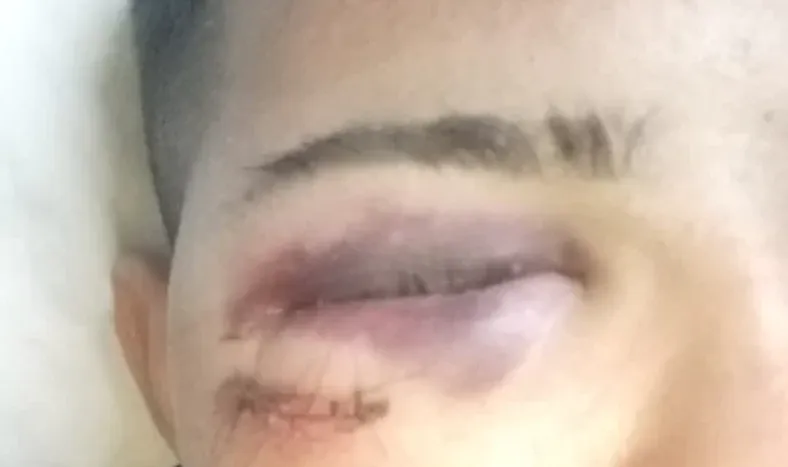 Una fractura en el costado izquierdo, una herida que debieron suturar con 8 puntos en el pómulo y la visión de uno de sus ojos comprometida. Ese es el cuadro de la lesión contra el chico de 16  años.