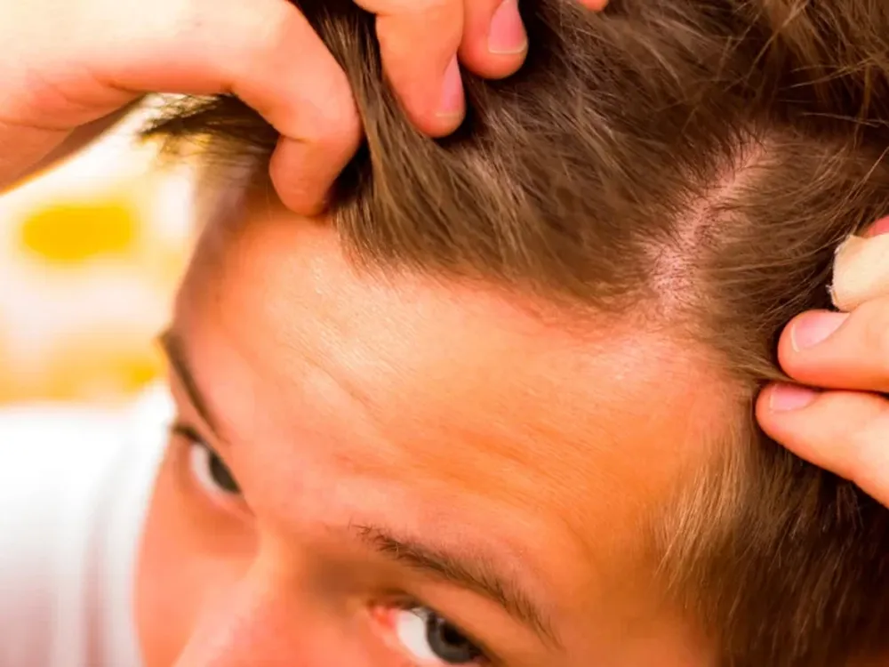 Caída del cabello: advierten que crecen las consultas de personas cada vez más jóvenes
