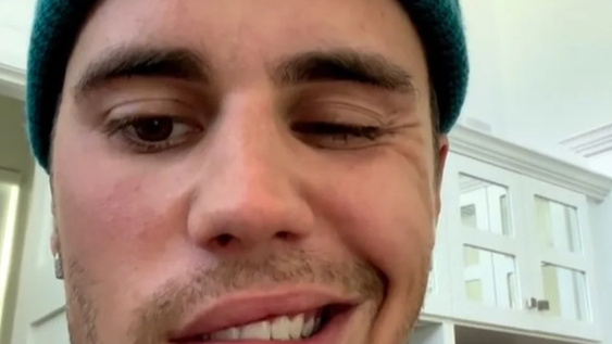 Con media cara paralizada por un virus, Justin Bieber cancela varios shows de su gira