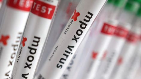 confirman el primer caso de viruela del mono en argentina