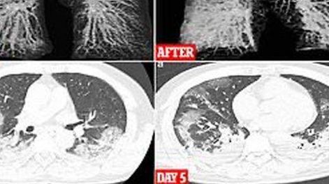 Crudas imágenes muestran el daño pulmonar que puede causar el coronavirus