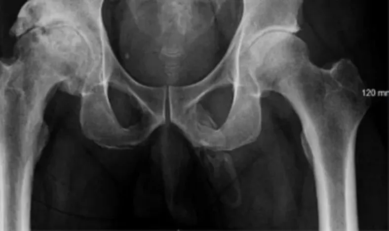 El extraño caso médico que está convirtiendo el pene de una persona en hueso