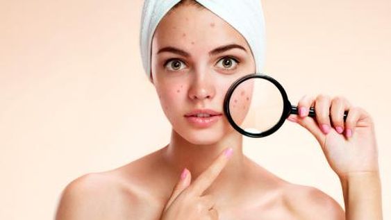 Cómo eliminar el acné y el paso a paso para que no queden marcas