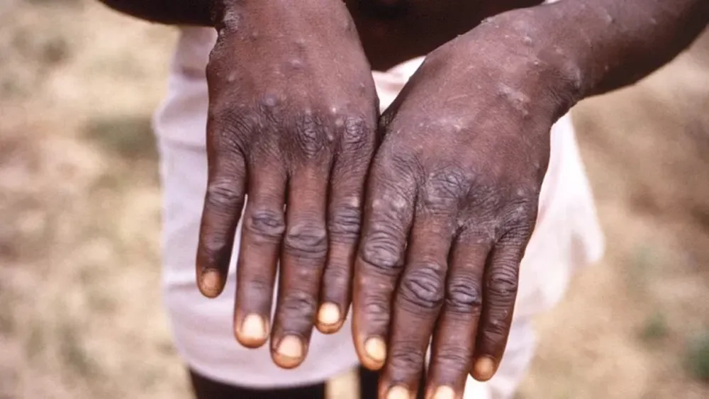 Detectaron el primer caso sospechoso de viruela del mono en la Argentina