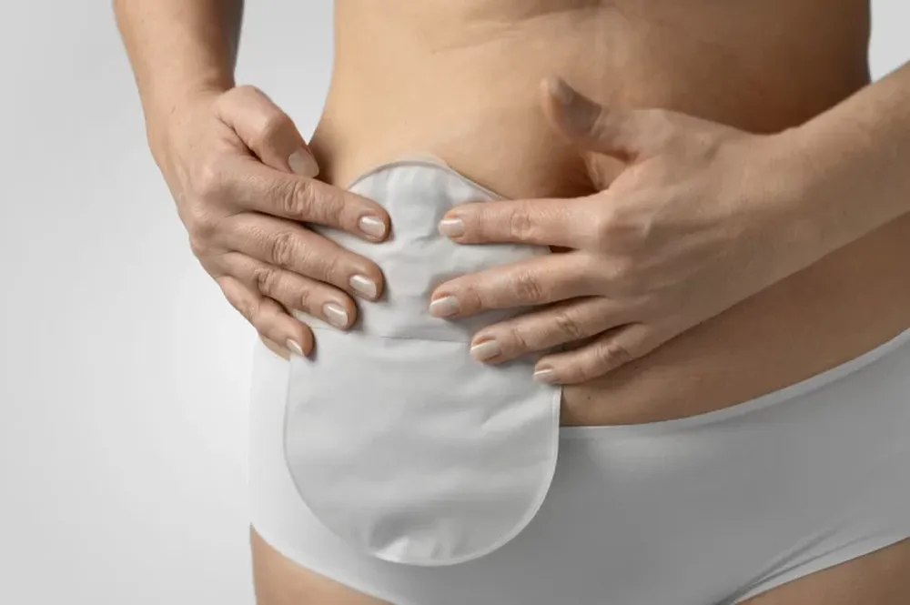 Sólo once provincias adhieren a una ley para los ostomizados