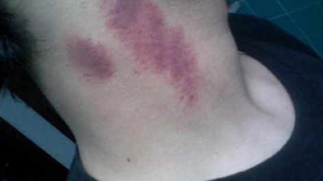 Un joven murió por el apasionado beso de su novia