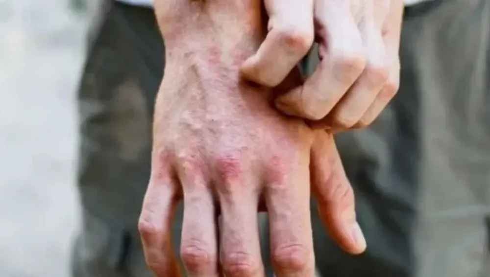 De qué se trata el síndrome de “dedos congelados”, nuevo síntoma del coronavirus