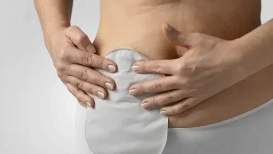 Sólo once provincias adhieren a una ley para los ostomizados