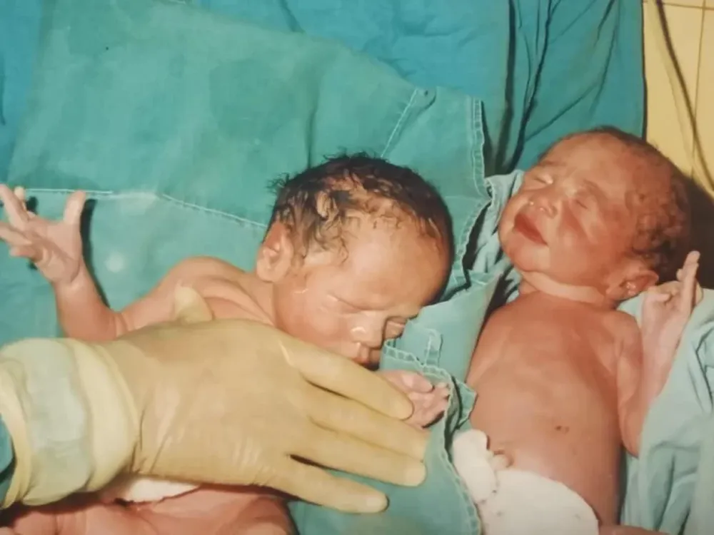 Euge y Edu, los bebés nacidos por fecundación in vitro que marcaron un hito en San Juan