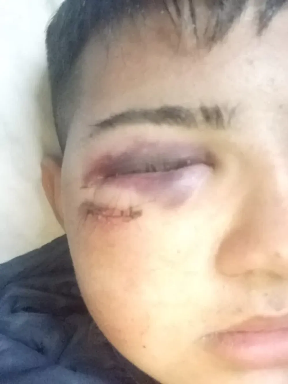 Una fractura en el costado izquierdo, una herida que debieron suturar con 8 puntos en el pómulo y la visión de uno de sus ojos comprometida. Ese es el cuadro de la lesión contra el chico de 16  años.