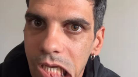 “Estoy atornillado entero”: el empresario de la noche brutalmente golpeado habló de su dura recuperación