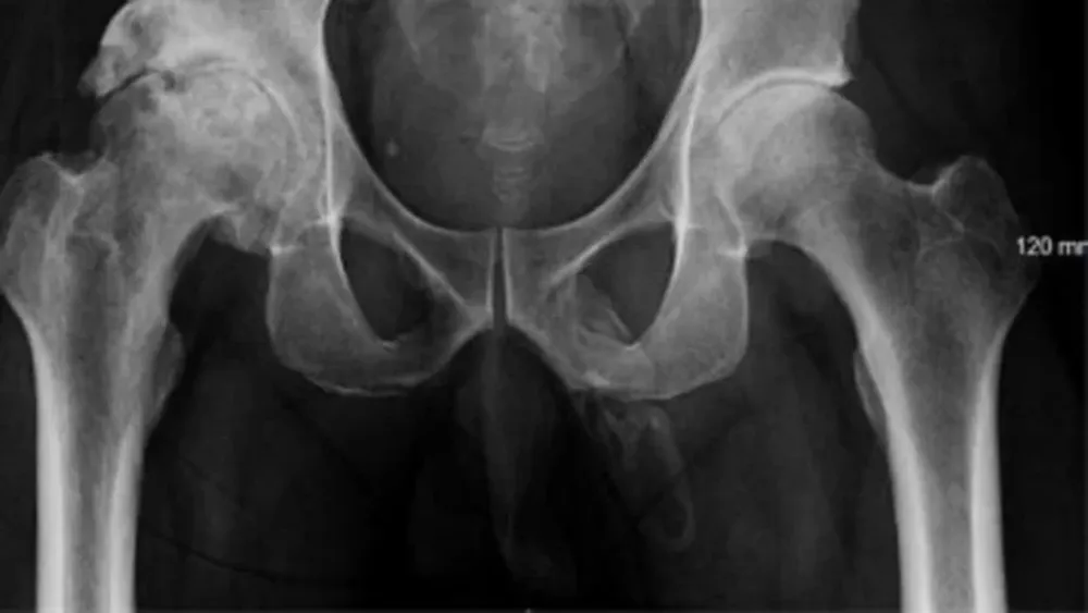 El extraño caso médico que está convirtiendo el pene de una persona en hueso