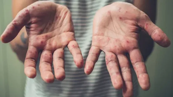 Alertan que el Sarampión puede volver a la Argentina