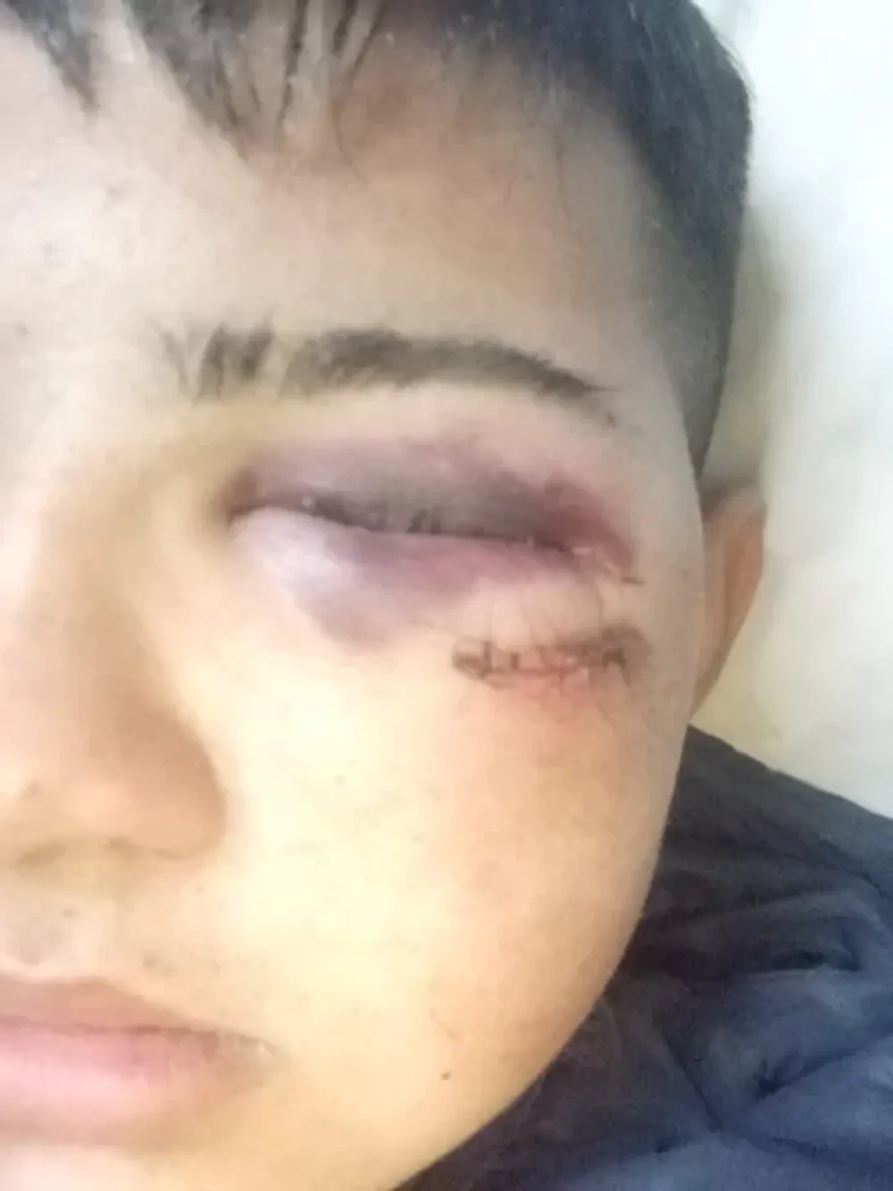 Hoy realizarán un examen en la zona del ojo al menor, para saber si la fractura pudo acarrear otras complicaciones.